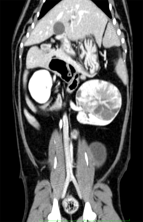 腎細胞癌 腹部造影CT画像
