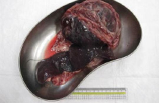 脾臓の血腫を伴う結節性過形成 摘出後の脾臓
