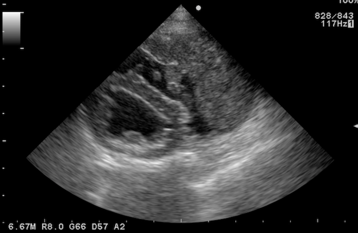 心臓の血管肉腫：図の右上（右心耳）に大きな腫瘍を形成している