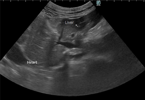 腹膜心膜横隔膜ヘルニア